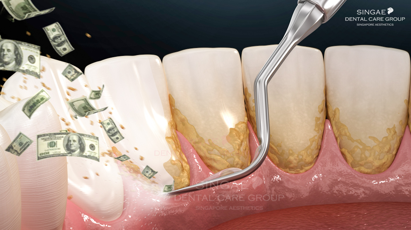 Bảng giá lấy cao răng ở Hà Nội hiện tại ở 10+ phòng khám