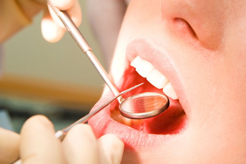 Có nên lấy cao răng không? Quy trình thực hiện và chi phí
