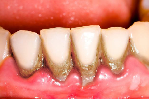 Gen di truyền và tác dụng phụ của thuốc