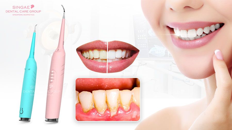 [Review] Top 9 máy lấy cao răng có chất lượng tốt nhất hiện nay 