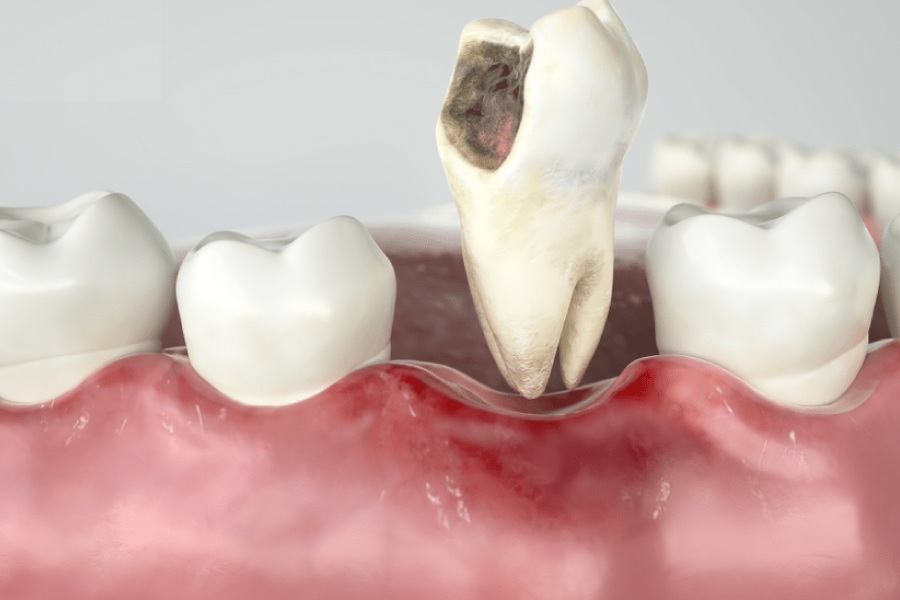Men răng là gì? Các vấn đề của men răng dễ gặp phải? 12 Men răng là gì? Vai trò của men răng?