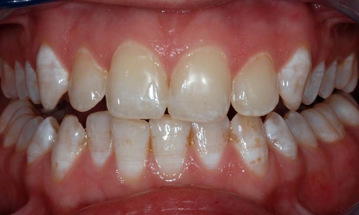 Men răng là gì? Các vấn đề của men răng dễ gặp phải? 14 Men răng là gì? Vai trò của men răng?