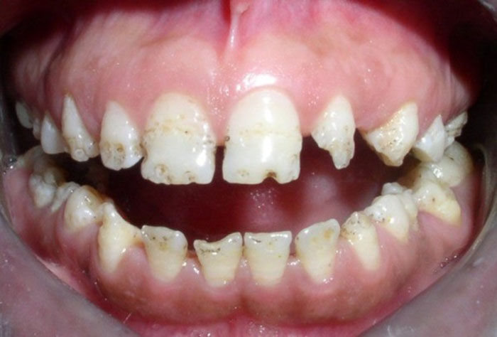 Men răng là gì? Các vấn đề của men răng dễ gặp phải? 15 men răng6