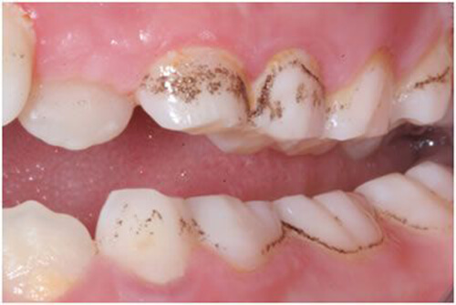 Kẽ răng bị đen do bệnh lý về răng