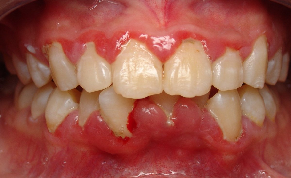 Điều trị viêm lợi giúp giảm đau răng