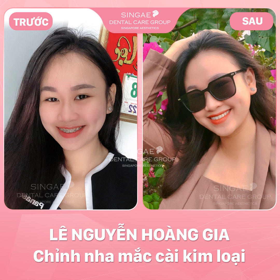 Hình ảnh khách hàng 27 Niềng Hoàng Gia