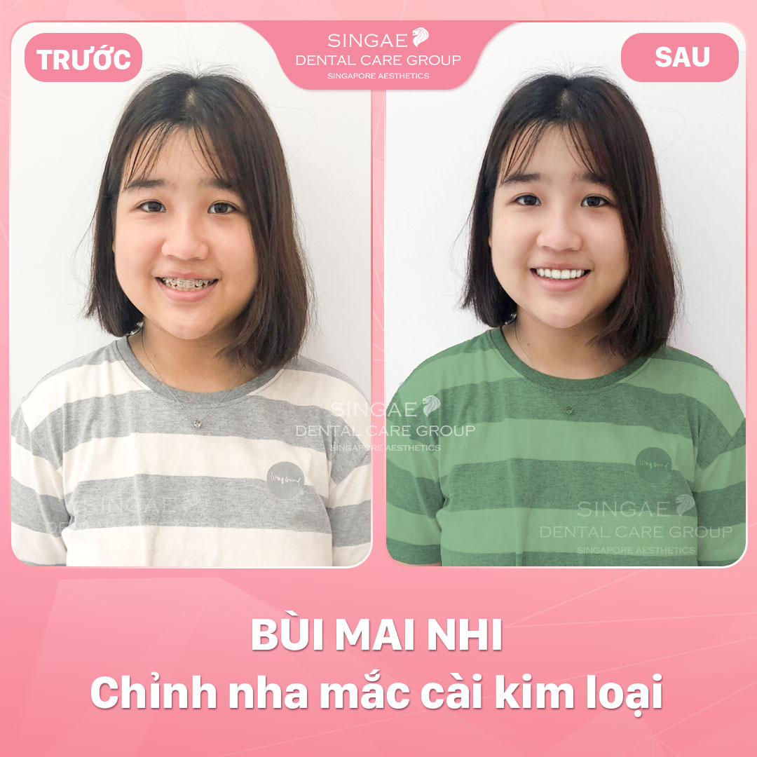Hình ảnh khách hàng 29 Niềng Mai Nhi