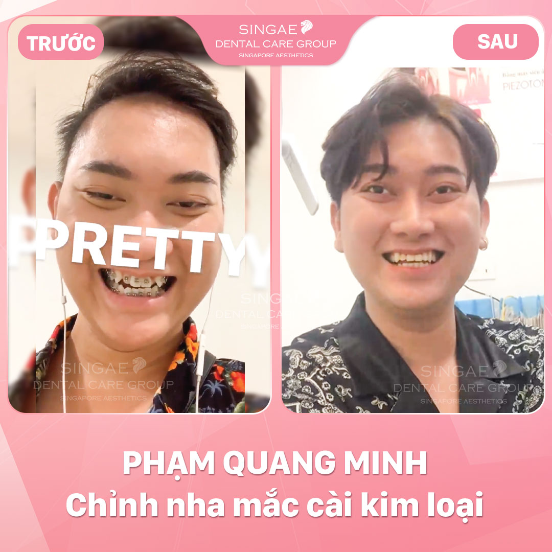 Hình ảnh khách hàng 30 Niềng Quang Minh