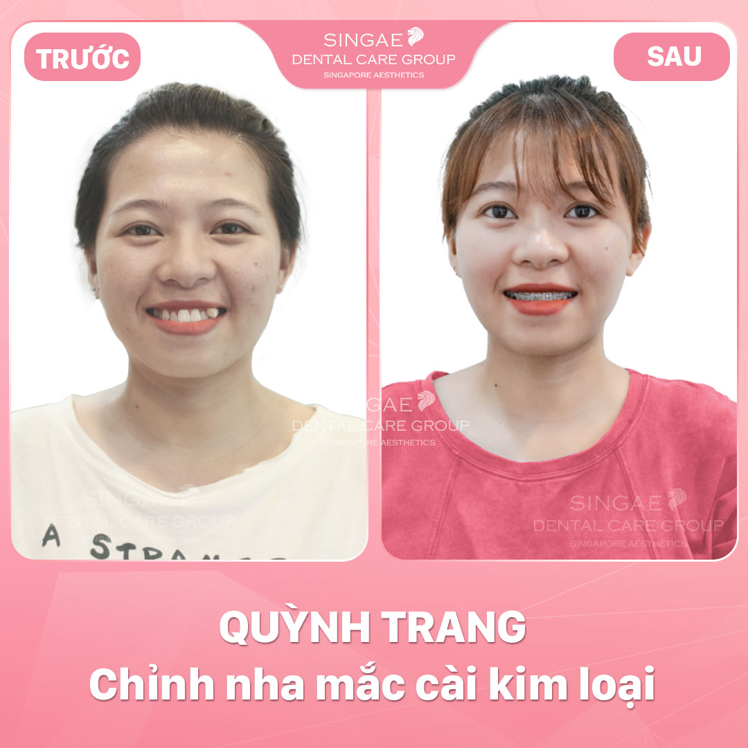 Hình ảnh khách hàng 28 Niềng Quỳnh Trang