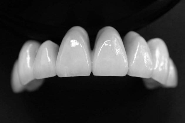 Răng sứ Cercon HT trắng sáng, tự nhiên