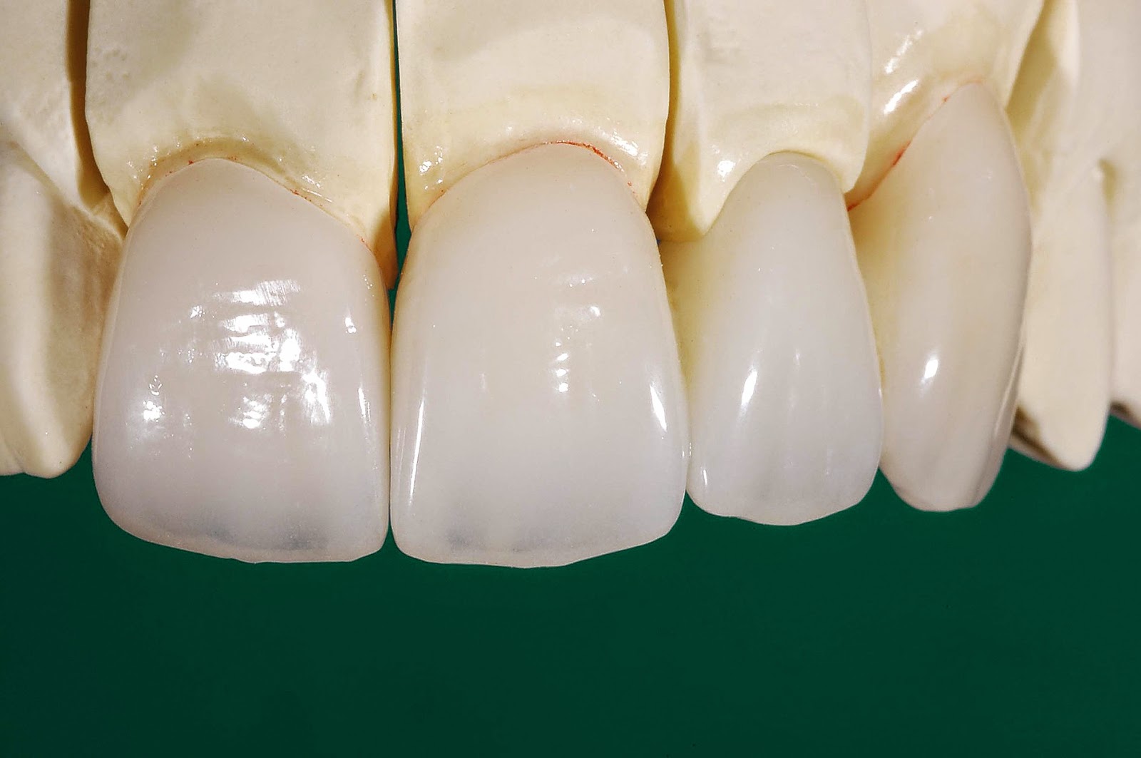 Bảng giá các loại răng sứ 