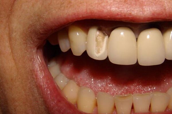 Mão sứ bị hỏng