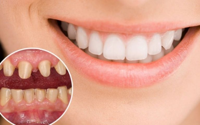 Bọc răng sứ lần 2