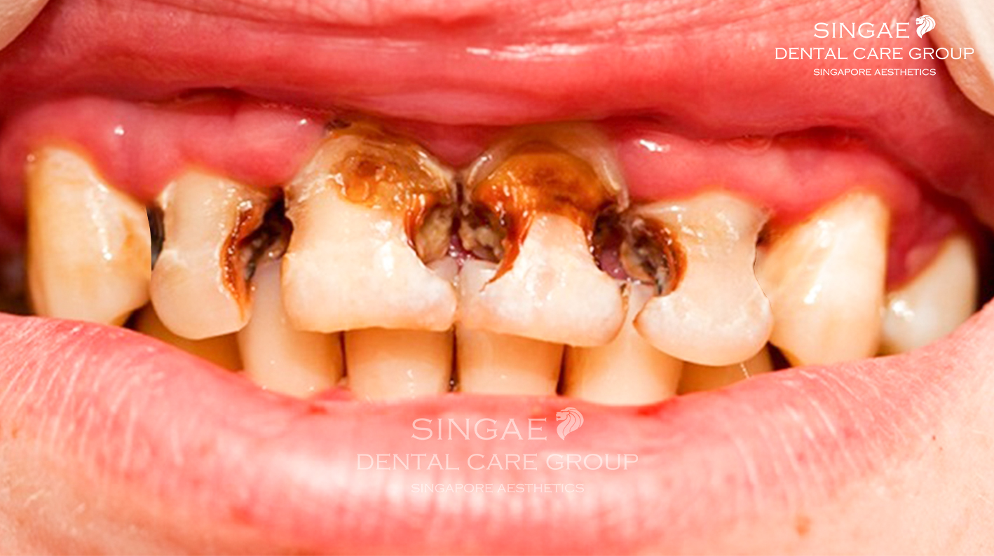 Tác dụng của nước súc miệng là gì? Có tốt hay không? 9 Tác dụng của nước súc miệng