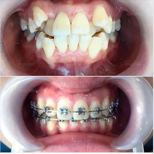 Răng khểnh trước và sau khi niềng