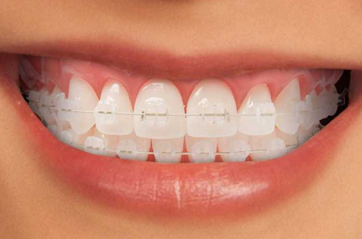 Niềng răng silicon là gì? Hàm Trainer có giá bao nhiêu? Niềng răng Silicon có tốt hay không? Có nên dùng hay không?