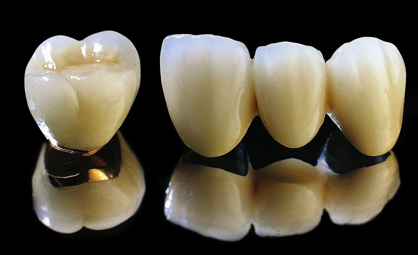 Thay răng sứ bao nhiêu tiền