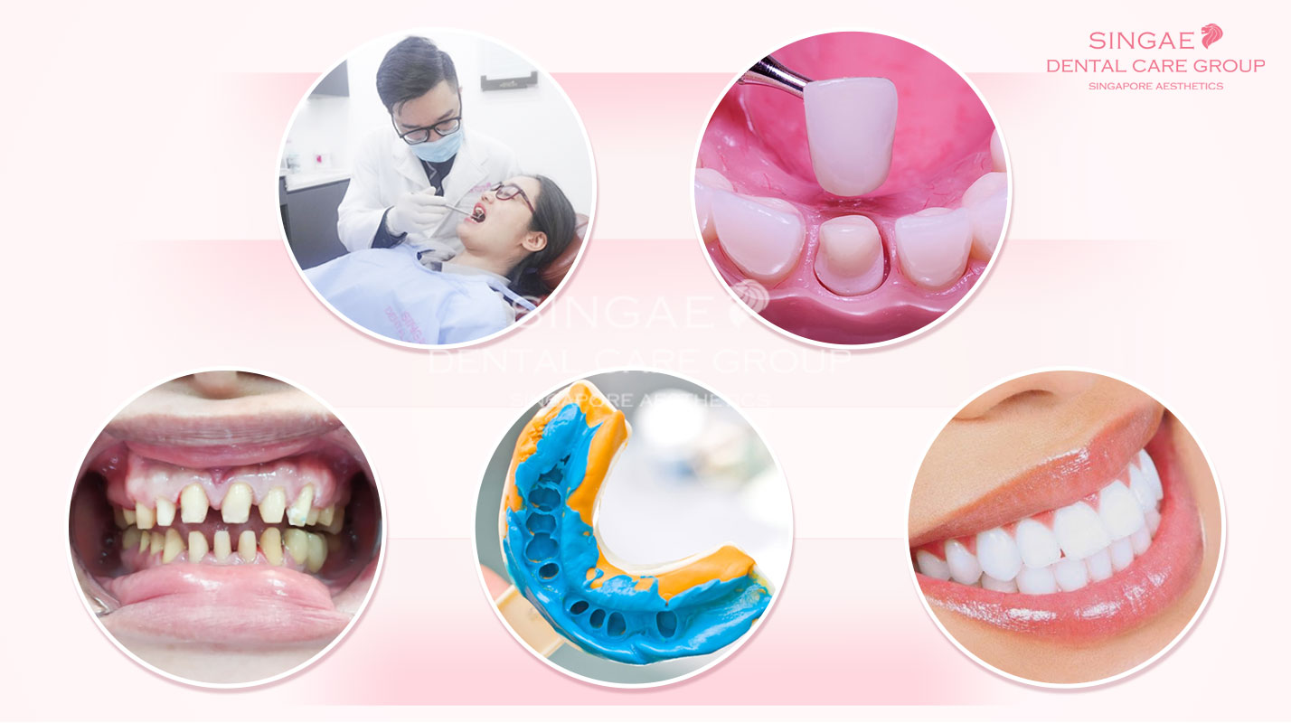Có nên tháo răng sứ ? 4+ Lưu ý sau khi tháo răng sứ 16 Tháo răng sứ có đau không