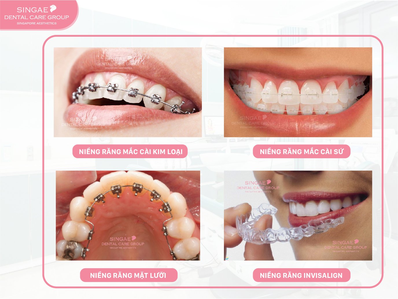 Niềng răng bao lâu thì có hàm răng đều, đẹp? 10 niềng răng bao lâu3
