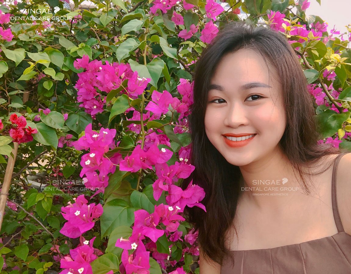 [ Niềng răng bao lâu ] thì có hàm răng đều, đẹp?