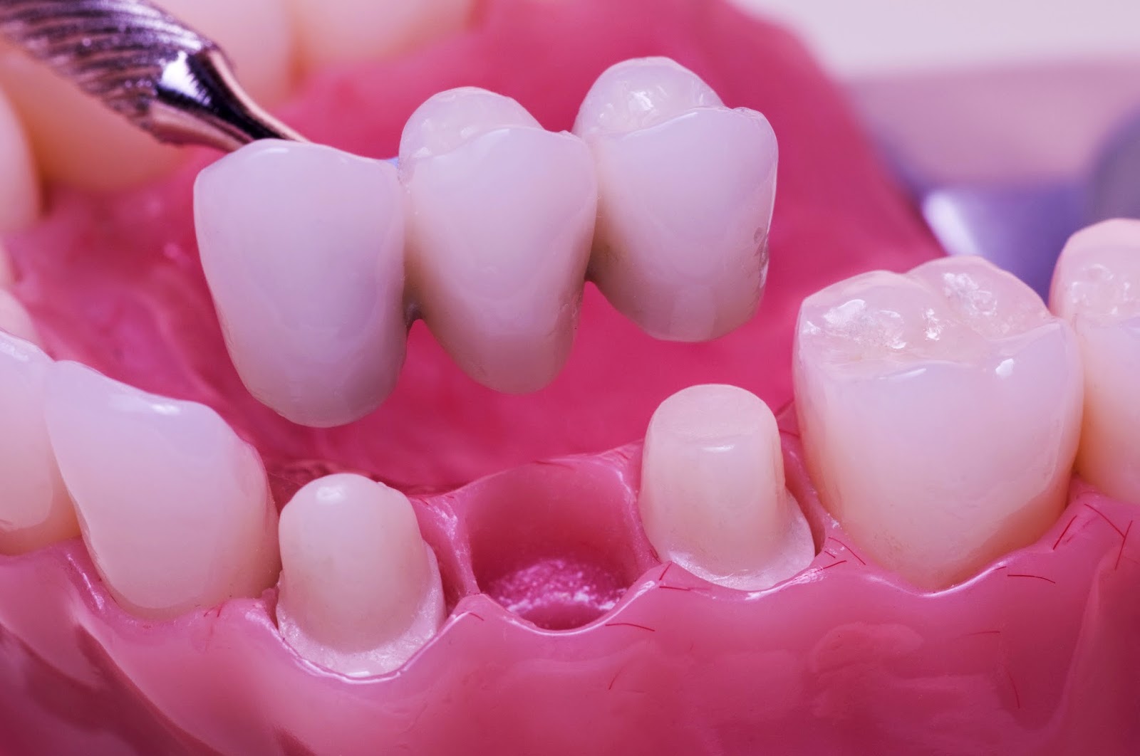 Cầu răng sứ có tốt không? Mất răng nên chọn phương pháp phục hình nào? 17 Cầu răng sứ