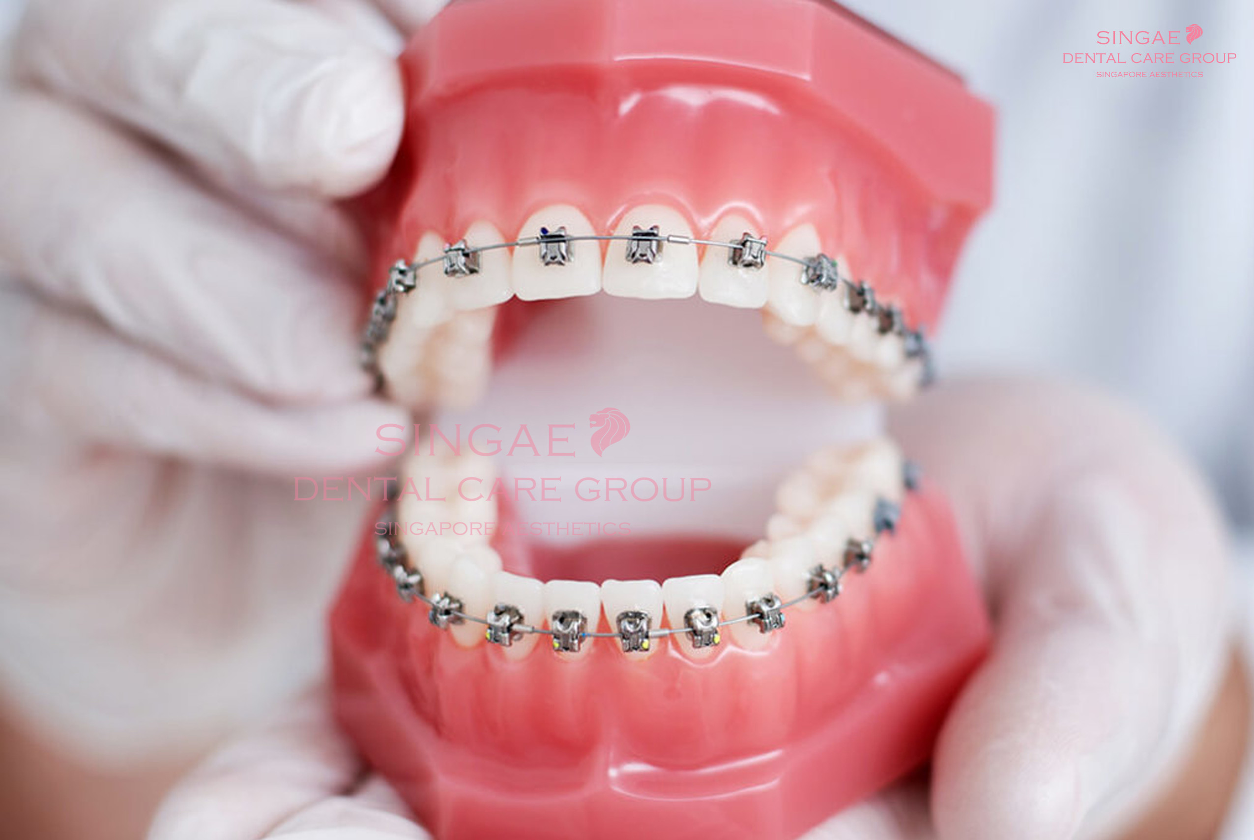 Trồng răng Implant có niềng được không 