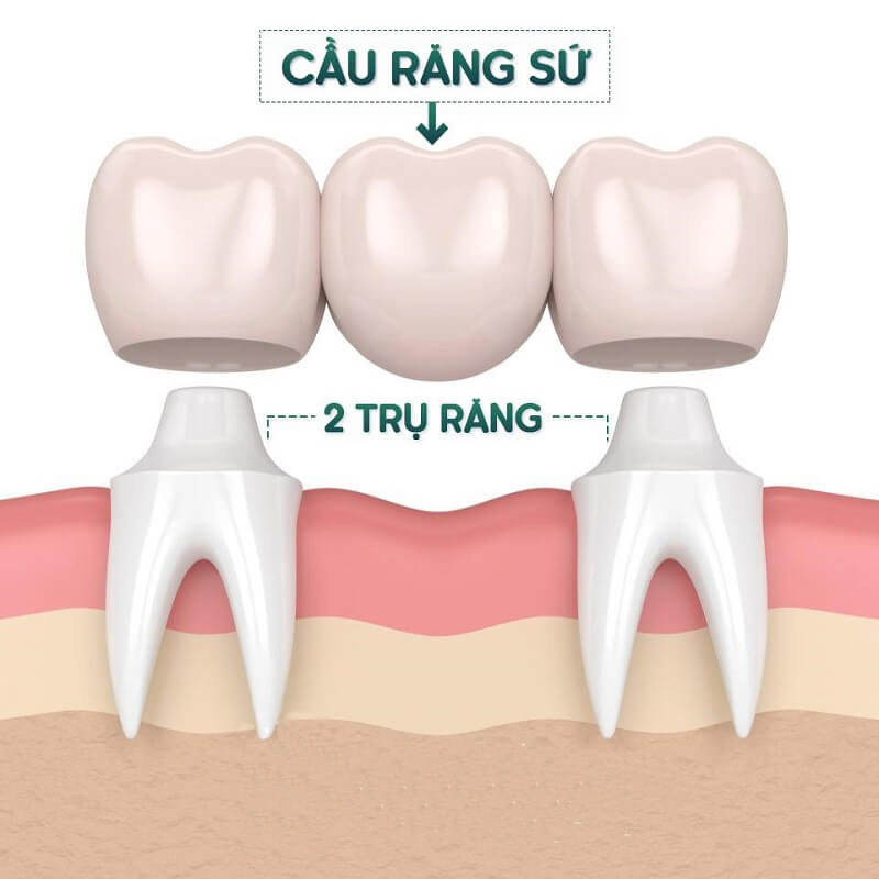 Hậu quả của việc mất răng 