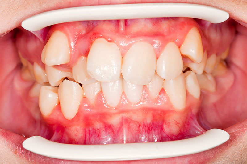 Răng khểnh là nơi trú ngụ lý tưởng của vi khuẩn