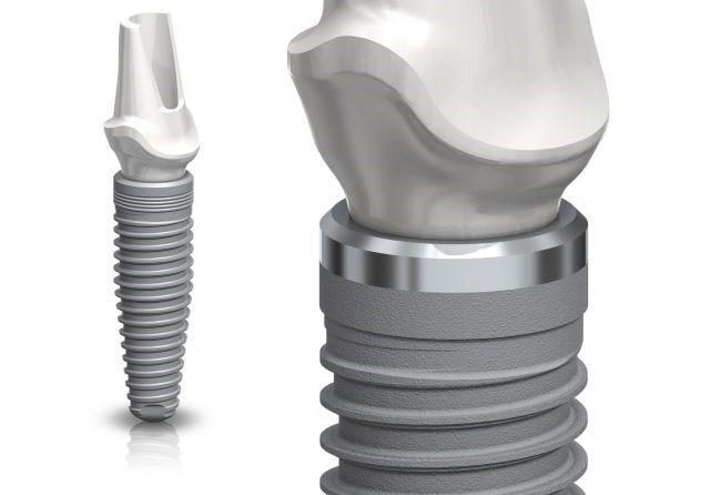 Trồng răng Implant toàn hàm all on 4, all on 6