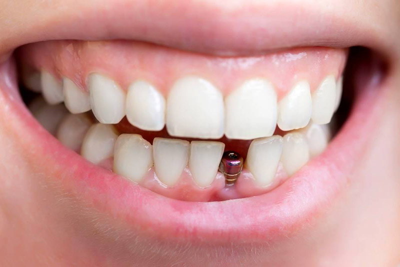 Trụ Implant Magicore