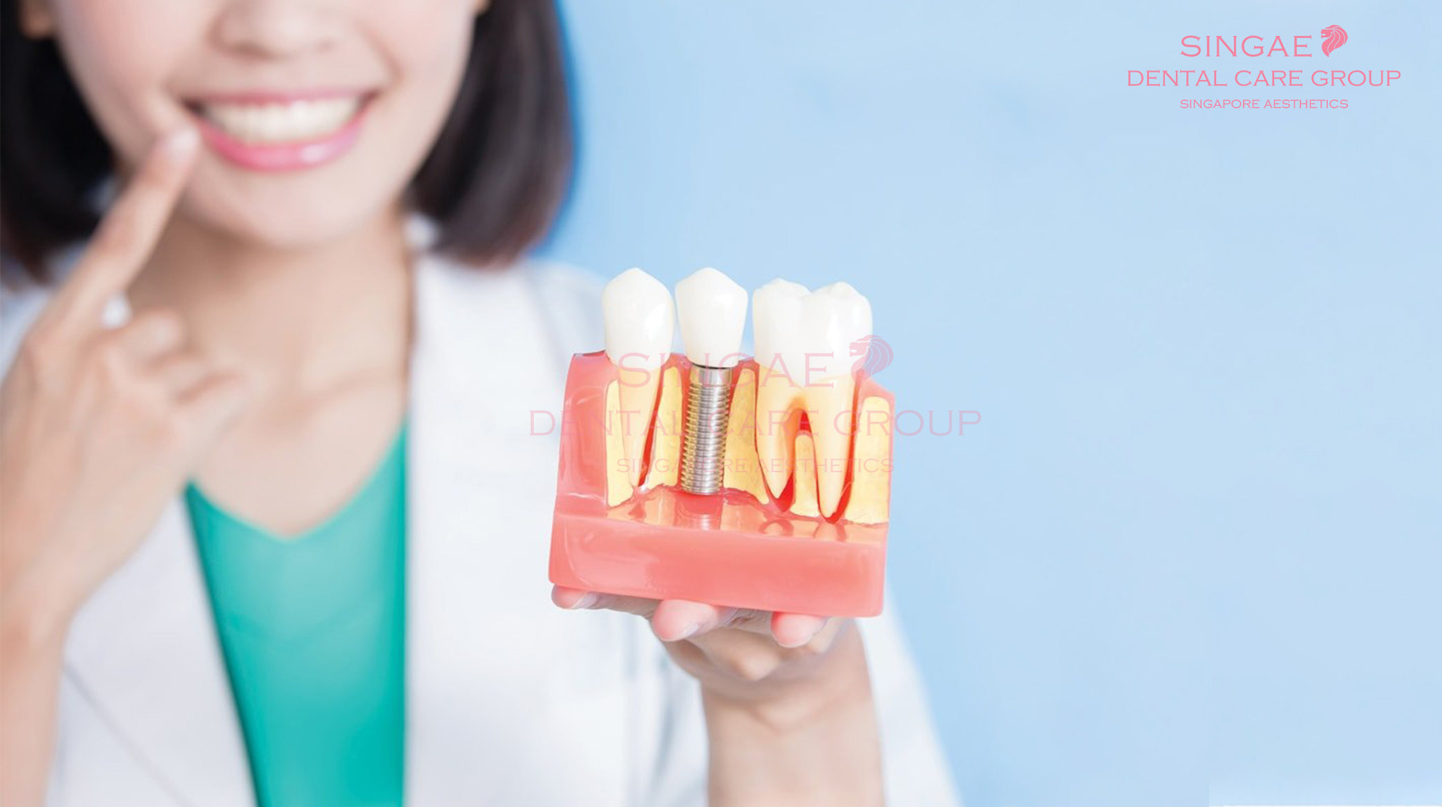 Trụ Implant SIC