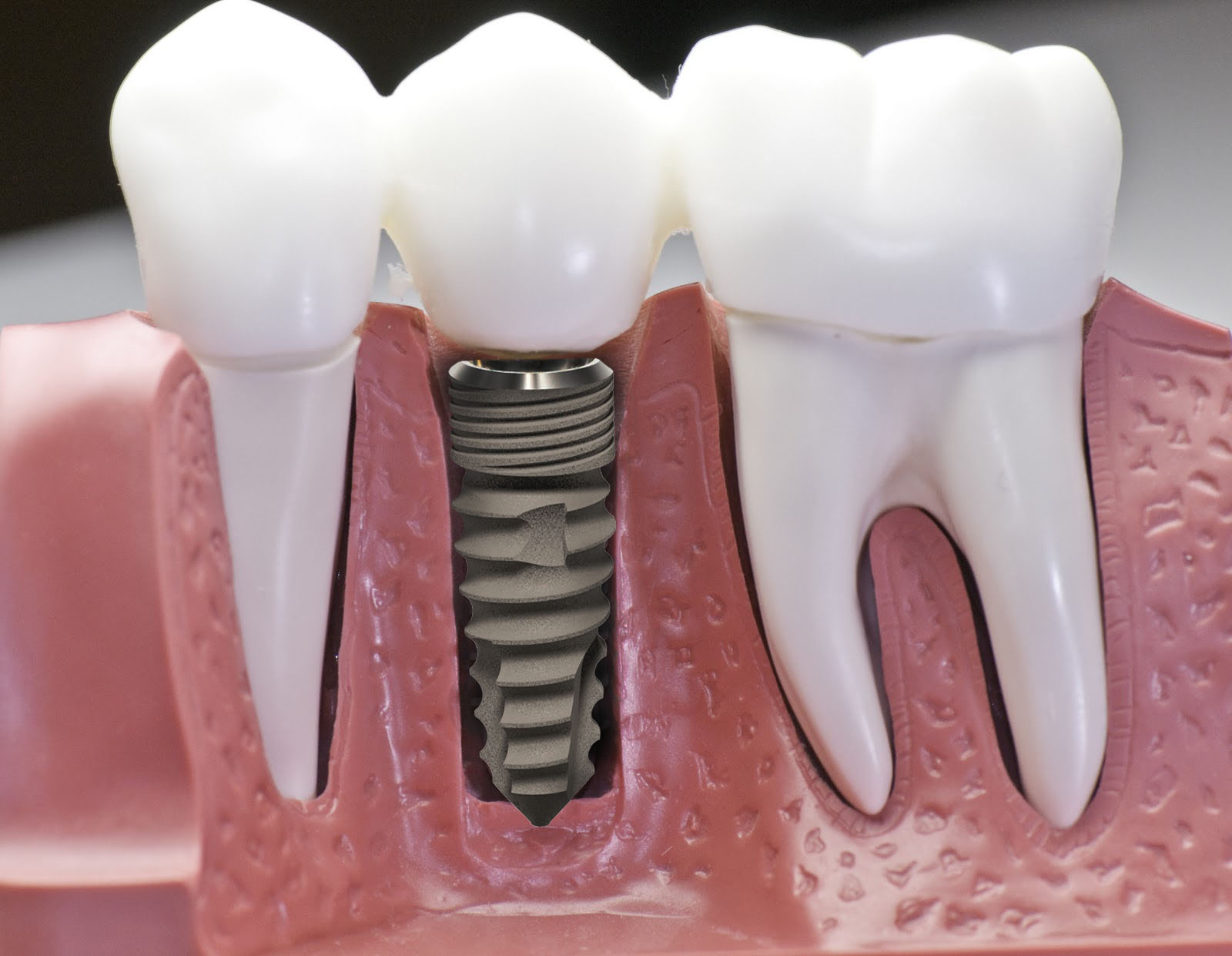 Trồng răng Implant có được vĩnh viễn không