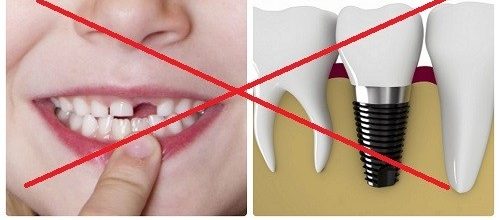 Trụ Implant SIC