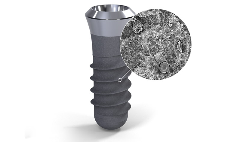 Trồng răng Implant toàn hàm all on 4, all on 6