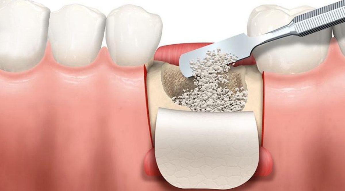 Implant giá rẻ