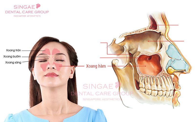 Nâng xoang hở 
