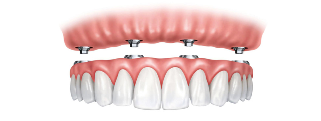 Trồng răng Implant all on 4, all on 6