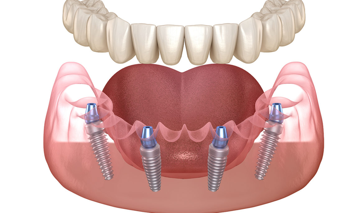 Cấy ghép Implant toàn hàm all on 4