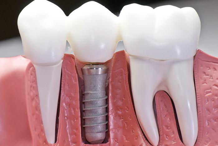 [ Bật mí ] Cấy ghép Implant đi được máy bay không?
