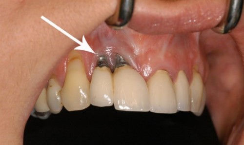 Hướng dẫn cách chăm sóc răng miệng sau khi cấy ghép trụ Implant