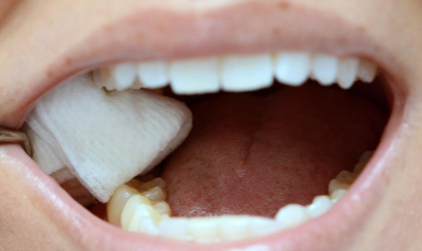 cấy ghép trụ implant1