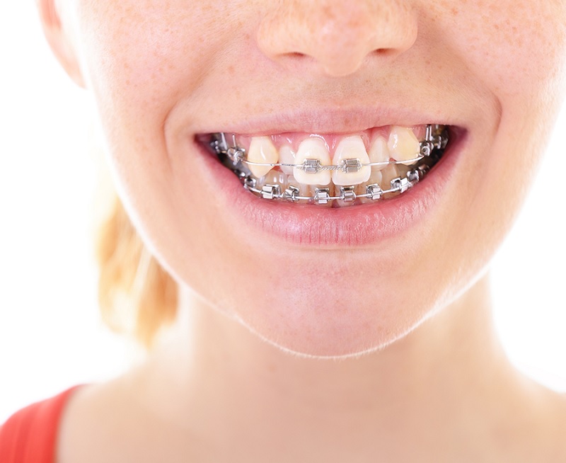 Răng khấp khểnh có niềng được không 
