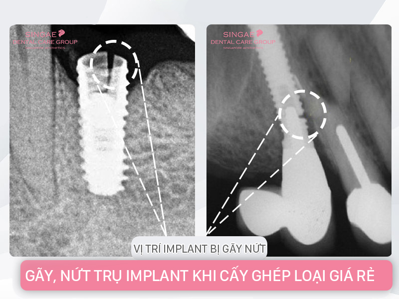 Trụ Implant bị lung lay: Nguyên nhân, Cách khắc phục 8 Trụ Implant bị lung lay: Nguyên nhân, Cách khắc phục