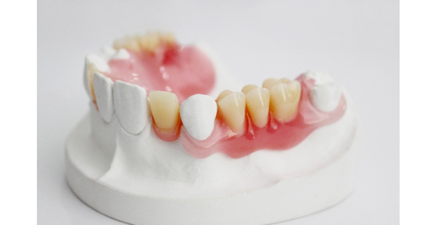 Mất nhiều răng: Nguyên nhân, hậu quả và cách khắc phục 7 Mất nhiều răng: Nguyên nhân, hậu quả và cách khắc phục