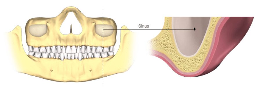 Nâng xoang trong cấy ghép Implant 