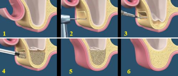 Nâng xoang trong cấy ghép Implant 