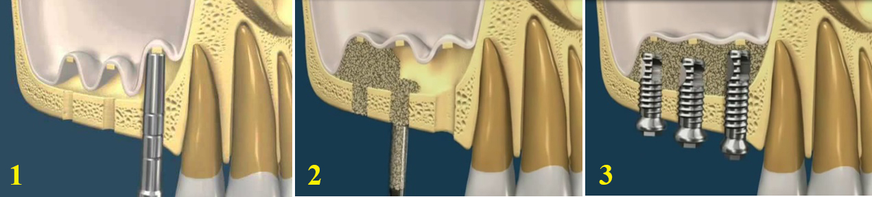 Nâng xoang trong cấy ghép Implant 