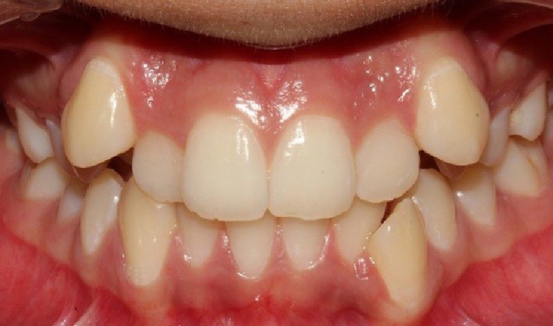 Răng khấp khểnh có bọc được sứ không 