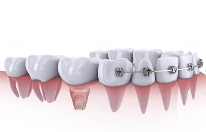 Trồng răng Implant có niềng được không?