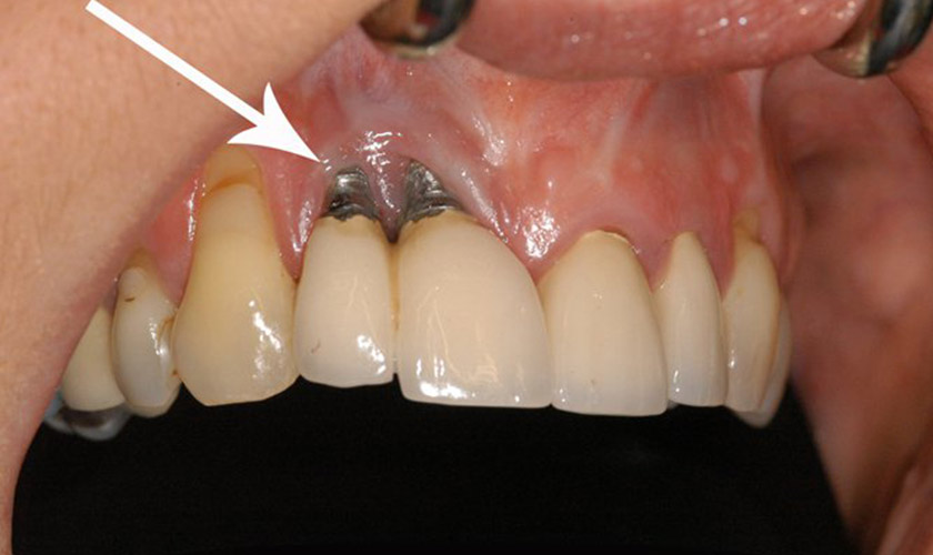 Trụ Implant bị lung lay: Nguyên nhân, Cách khắc phục 7 Trụ Implant bị lung lay: Nguyên nhân, Cách khắc phục